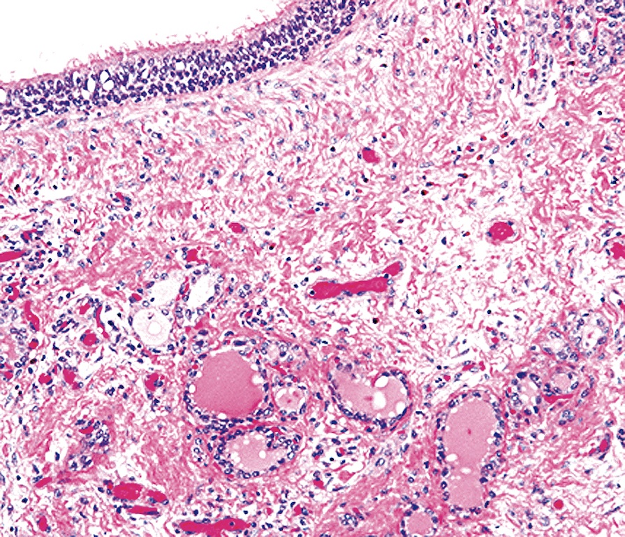 Pathology Outlines - Thyroglossal Duct Cyst